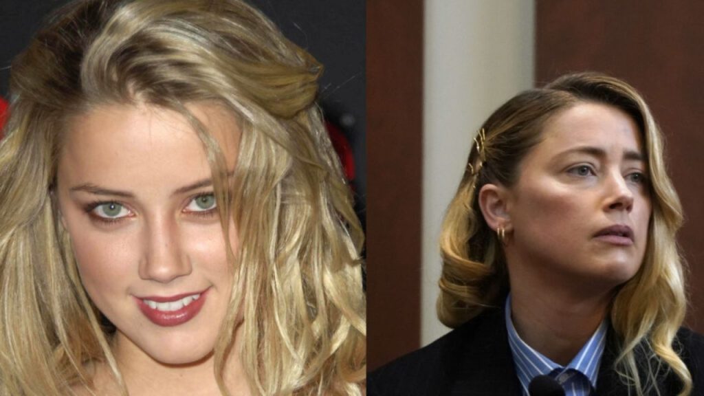Amber Heard's Plastic Surgery: Rhinoplasty, Lip Fillers, Cheek Implants!