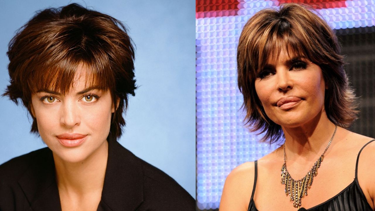 Lisa Rinna's Plastic Surgery Lips: The Real Housewives of Beverly Hills Star's Lip Injections and Reduction Surgery!
