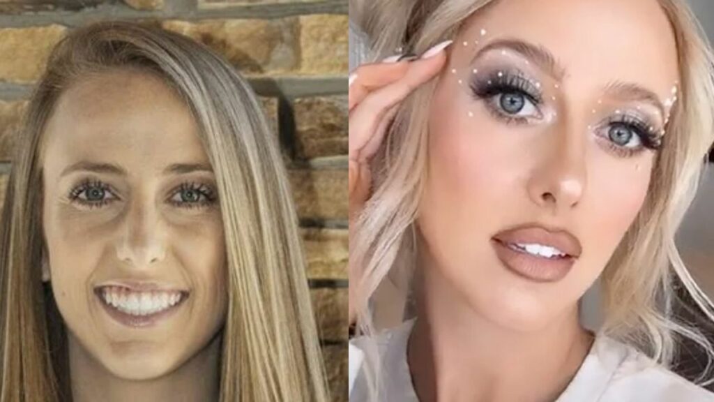 Brittany Mahomes' Plastic Surgery: Did She Get Lip Fillers and Breast Implants?