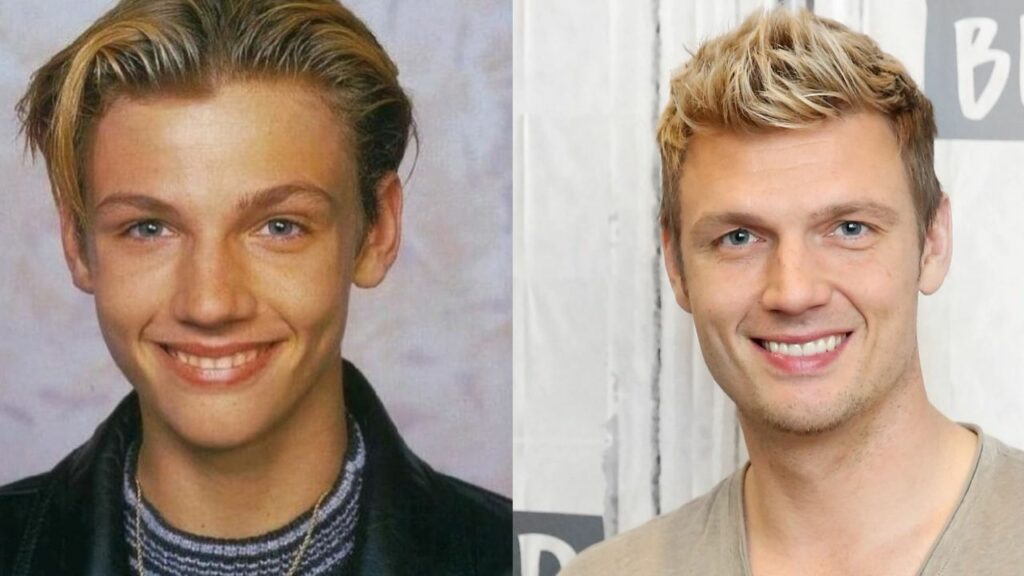 Nick Carter's Plastic Surgery: Has The Shape of The Singer's Mouth Changed?