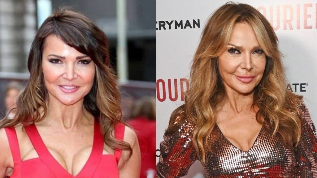 Lizzie Cundy's Plastic Surgery: What Procedure Has the Former WAG Had?