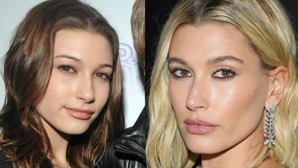 Hailey Bieber's Plastic Surgery: Has the Model Gotten Lip Fillers, a Nose Job, and Chin Augmentation? Check out the Before and After Pictures!