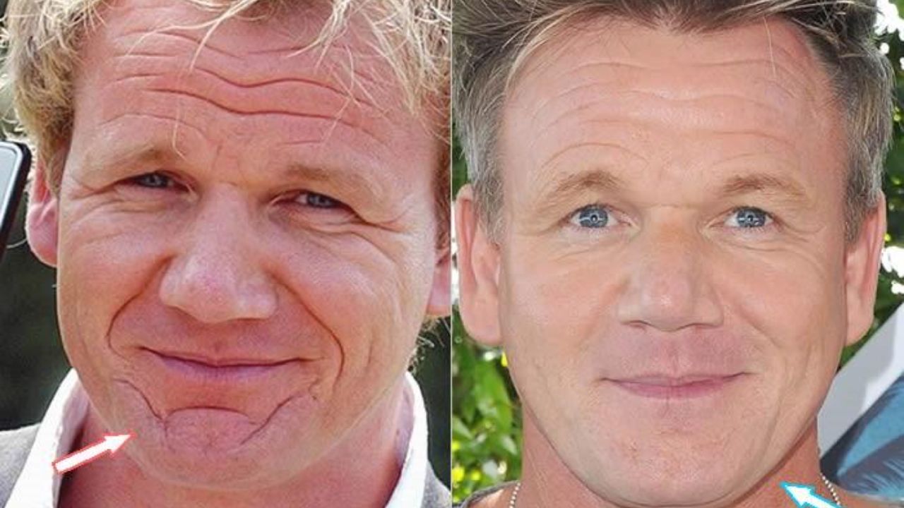 Gordon Ramsay before and after plastic surgery. houseandwhips.com