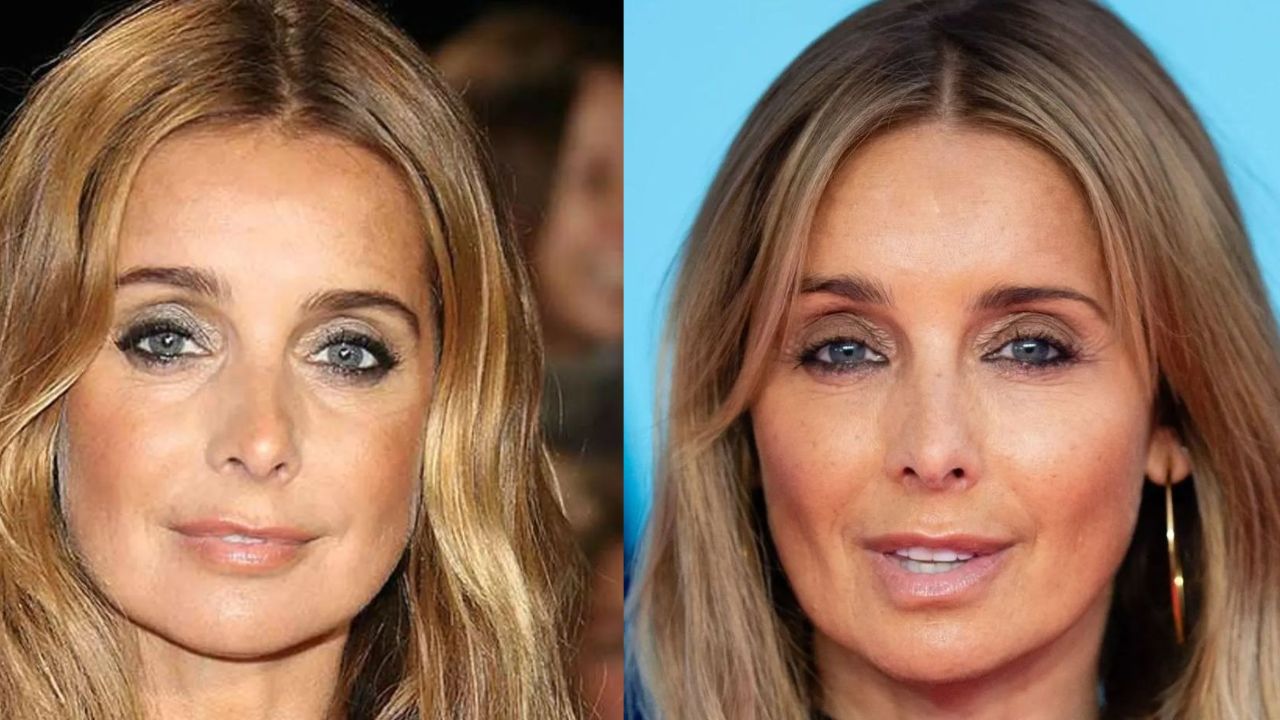 Louise Redknapp before and after rumored plastic surgery. houseandwhips.com