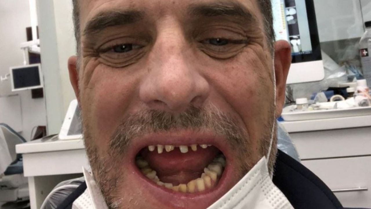 Hunter Biden's teeth decayed as a result of his crack addiction. 
houseandwhips.com
