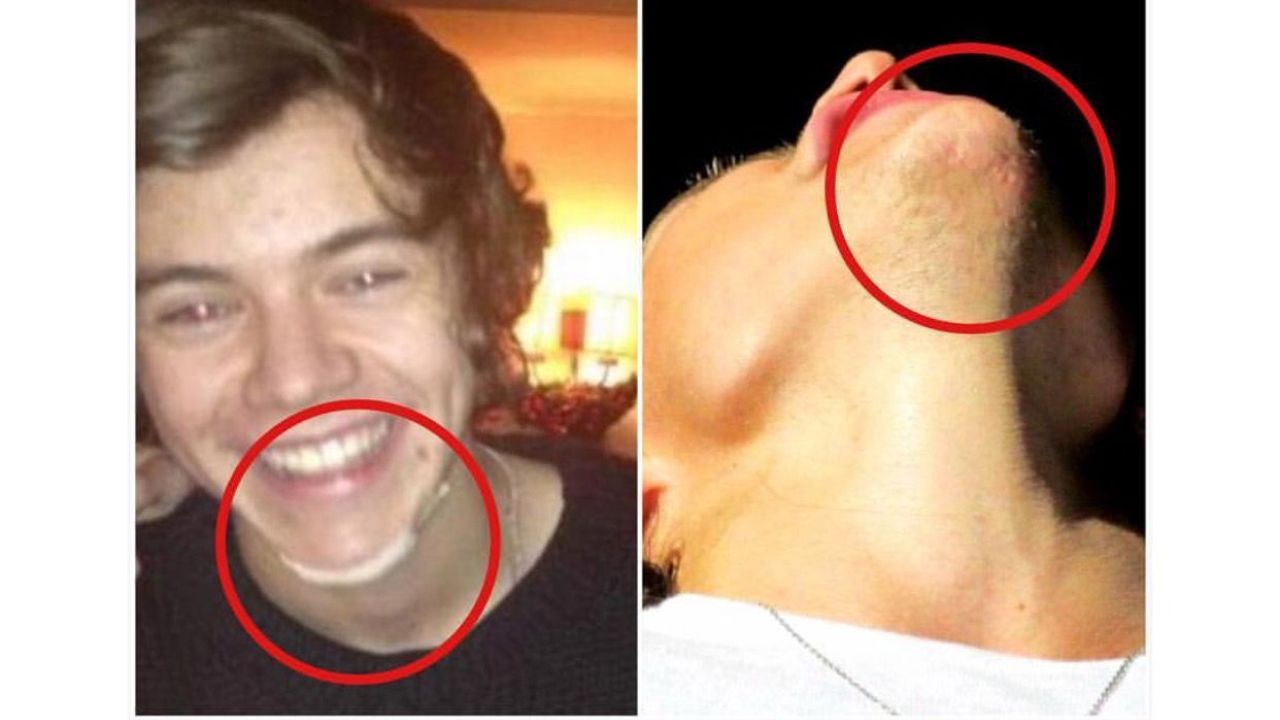 Harry Styles has a chin scar and there's an interesting story behind it. houseandwhips.com