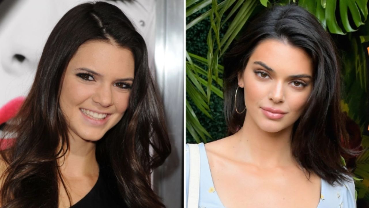 Kendall Jenner before and after plastic surgery. houseandwhips.com