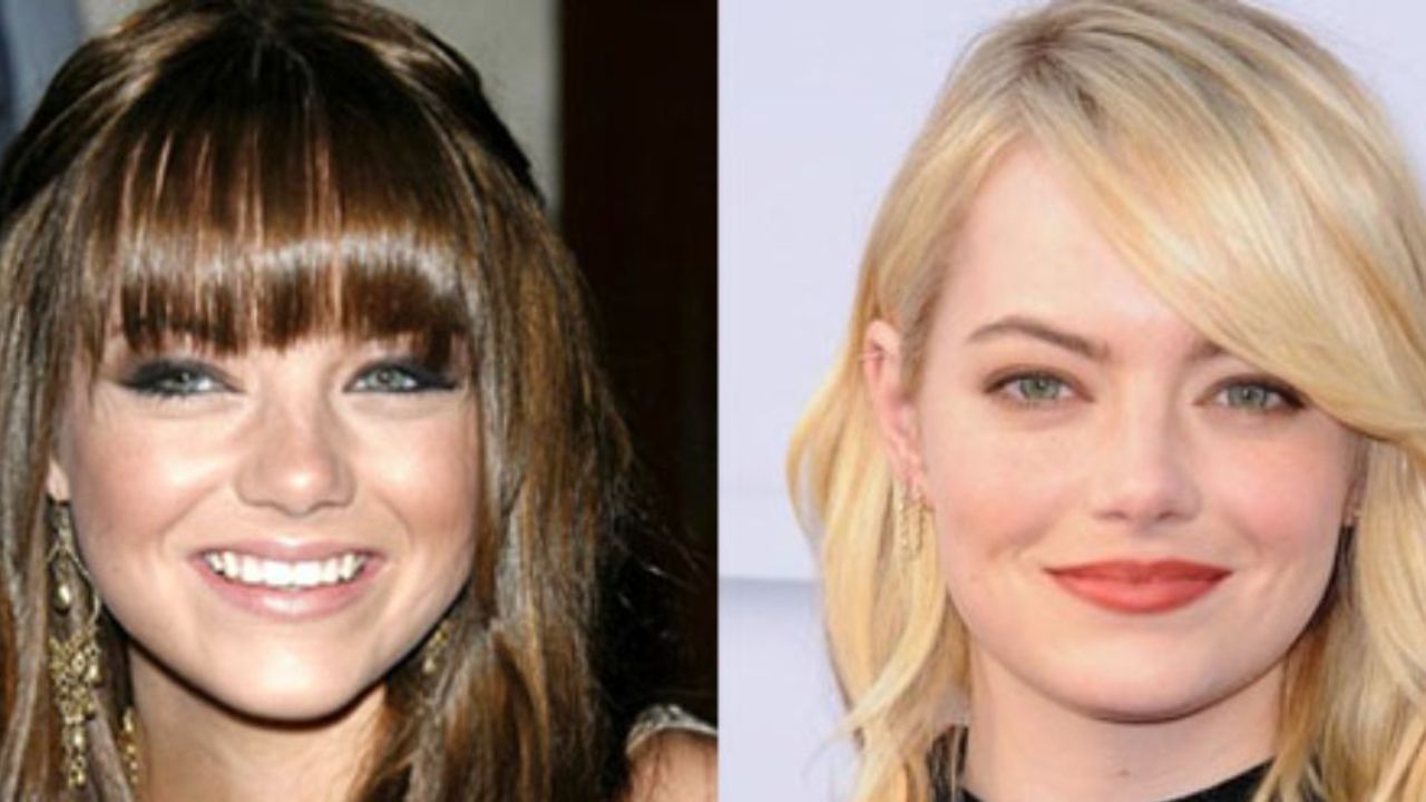 Emma Stone before and after plastic surgery. houseandwhips.com