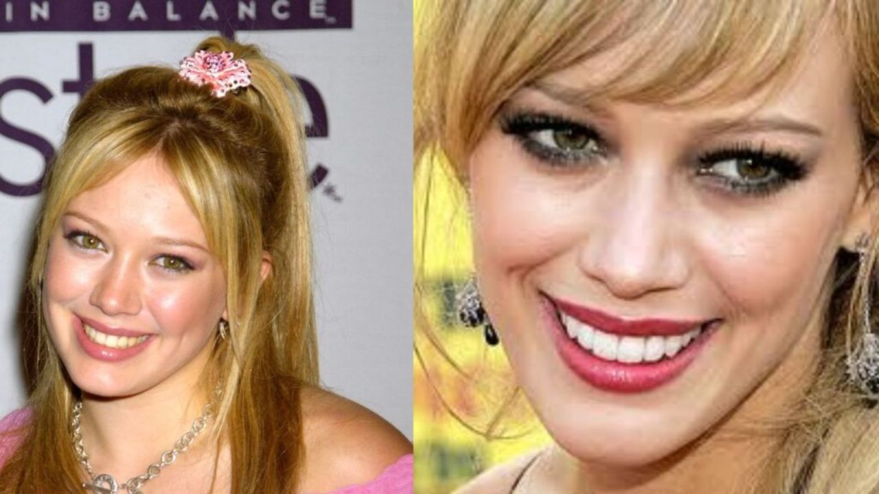 Hilary Duff's Plastic Surgery: Take a Look At The Actress' Pictures Before and After Veneers!
