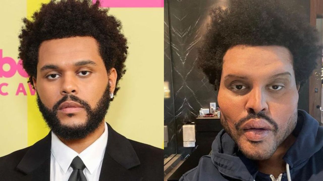 Reddit: The Weeknd’s Plastic Surgery; Why Was Save Your Tears Singer’s Face & Nose Bruised Back in 2020?