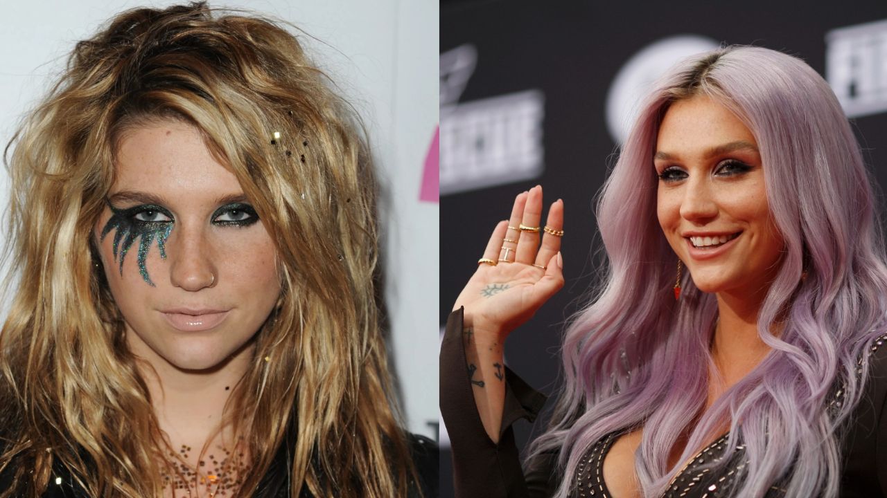 Kesha’s Plastic Surgery: Before and After Transformation Explored!