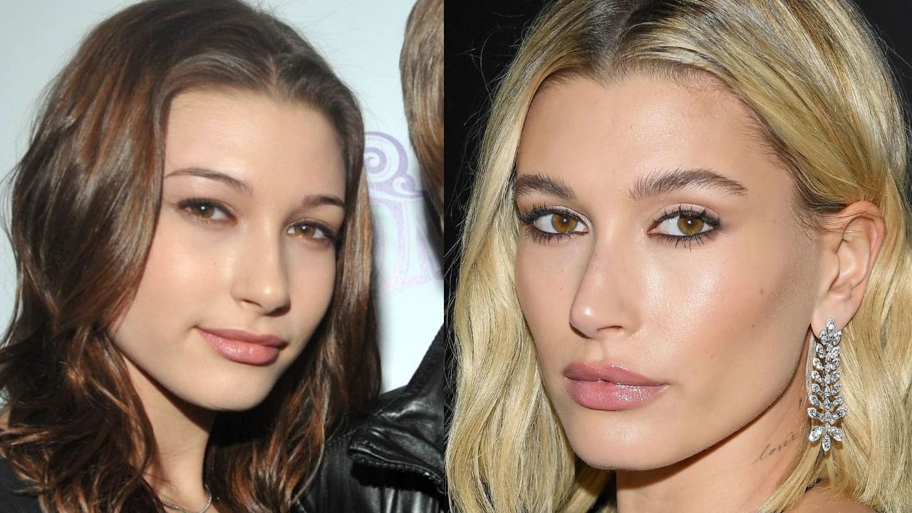 Hailey Bieber's Plastic Surgery: Has the Model Gotten Lip Fillers, a Nose Job, and Chin Augmentation? Check out the Before and After Pictures!