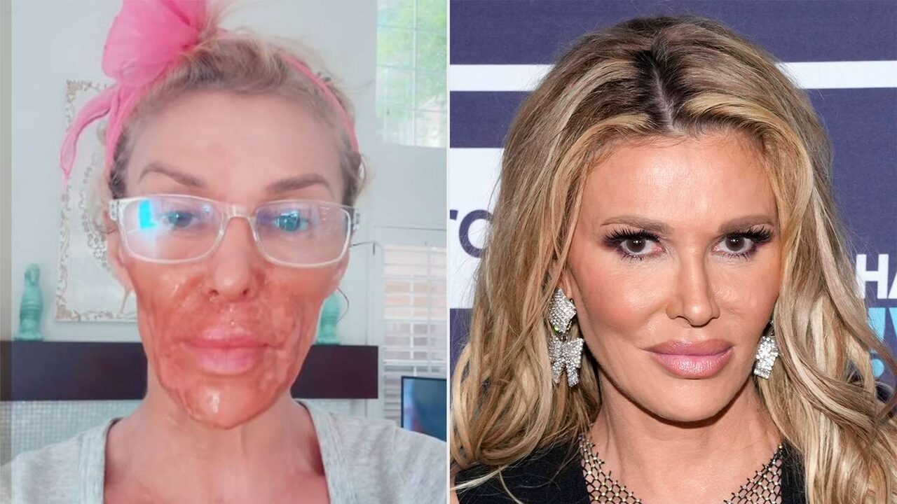 Brandi Glanville Facial Parasite: How Did She Burn Her Face?
